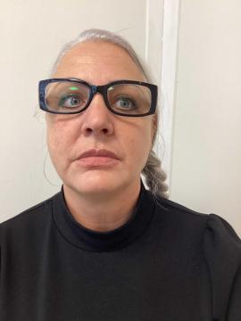 Lipfillers foto van Kliniek Zuyd (na)
