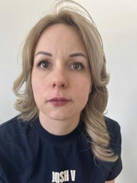 Lipfillers foto van Kliniek Zuyd (na)