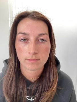 Lipfillers foto van Kliniek Zuyd (voor)