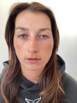 Lipfillers foto van Kliniek Zuyd (na)