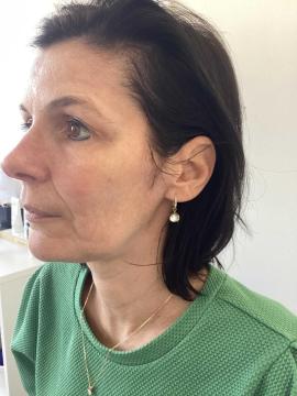 Photo Radiesse de Kliniek Zuyd (avant)