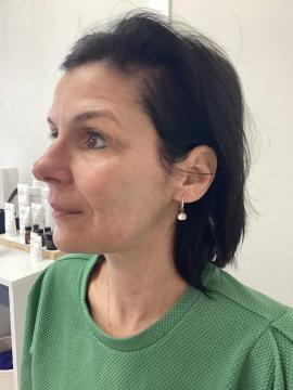 Photo Radiesse de Kliniek Zuyd (après)