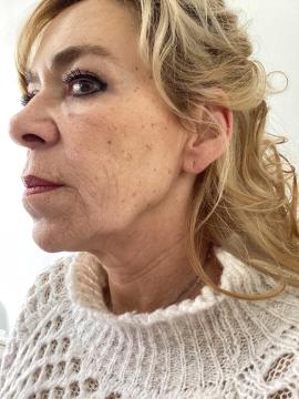 Photo Radiesse de Kliniek Zuyd (avant)
