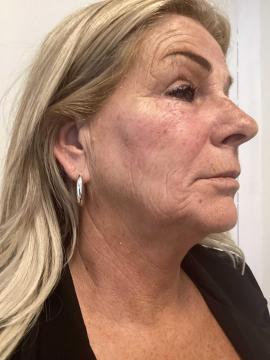 Photo Radiesse de Kliniek Zuyd (après)