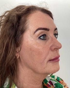 Fillers foto van Kliniek Zuyd (na)