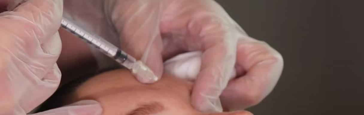 Injectables treatment for wrinkles in Burton upon Trent at Top Aesthetics Ltd