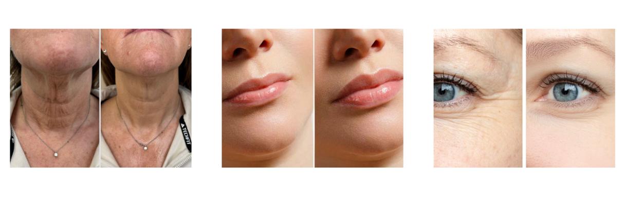 Injectables treatment for wrinkles in Wigan at Complexion Perfection Medical Aesthetics | Skincare |Wellbeing