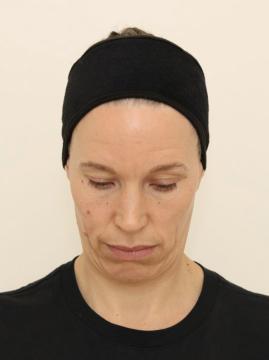 Fillers foto van IKI Clinic (voor)