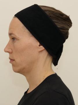 Fillers foto van IKI Clinic (voor)