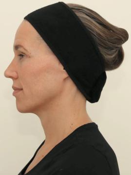 Fillers foto van IKI Clinic (na)