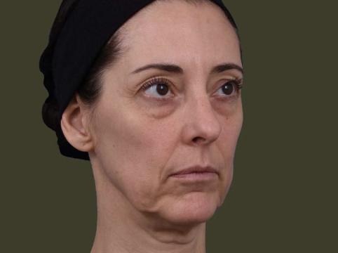Fillers foto van IKI Clinic (voor)