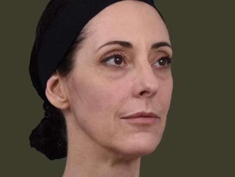 Fillers foto van IKI Clinic (na)