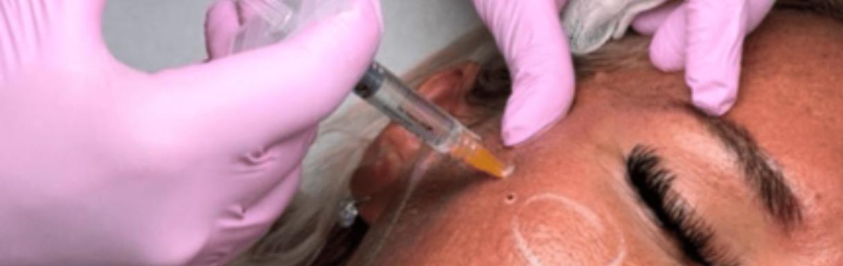 Injectables treatment for wrinkles in Witham at HB Aesthetics