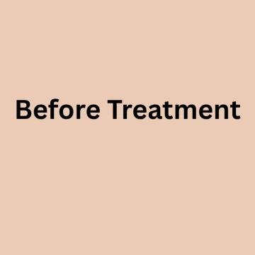 Botox foto van Test Clinic (voor)