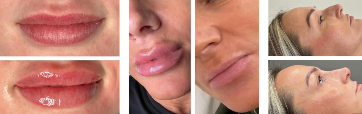 Injectables treatment for wrinkles in Brentwood at Danielle’s Aesthetics