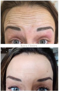 Voorhoofdsrimpels foto van Koca Clinics Tiel (voor)