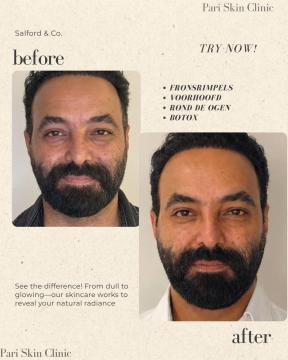 Botox voor/na van Pari Skin Clinic (na)