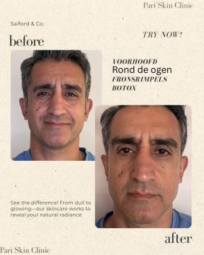 Botox voor/na van Pari Skin Clinic (voor)