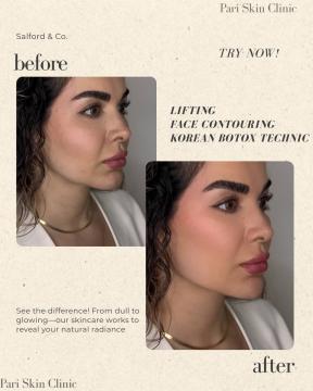 Botox voor/na van Pari Skin Clinic (na)