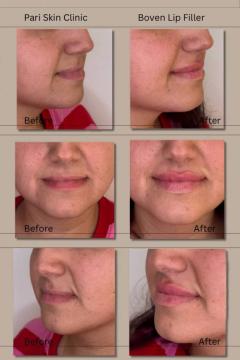 Fillers met lidocaïne voor/na van Pari Skin Clinic (na)
