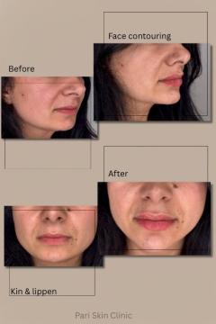 Fillers met lidocaïne voor/na van Pari Skin Clinic (voor)