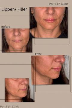 Fillers met lidocaïne voor/na van Pari Skin Clinic (voor)