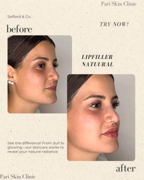 Fillers met lidocaïne voor/na van Pari Skin Clinic (na)