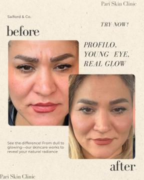 Profhilo voor/na van Pari Skin Clinic (na)