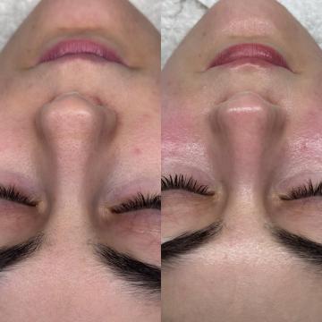 Huidverbetering voor/na van Pari Skin Clinic (voor)