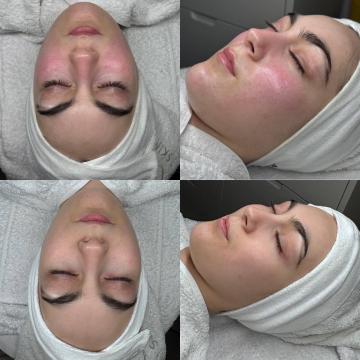 Huidverbetering voor/na van Pari Skin Clinic (na)