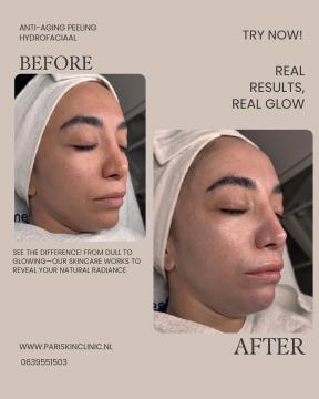 Huidverbetering voor/na van Pari Skin Clinic (na)