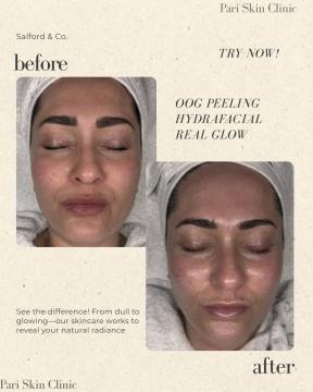 Huidverbetering voor/na van Pari Skin Clinic (voor)