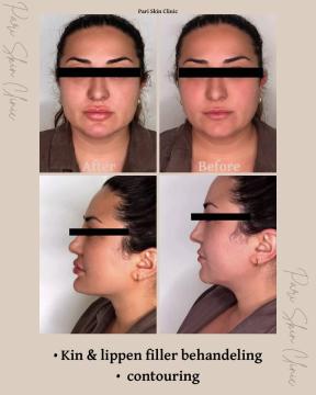 Fillers met lidocaïne voor/na van Pari Skin Clinic (na)