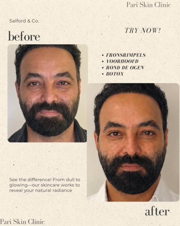 20% off op fillers & 25% off op Botox