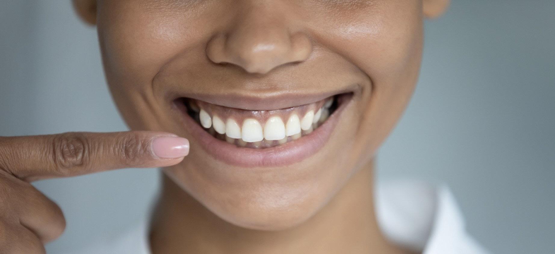 Gummy Smile
