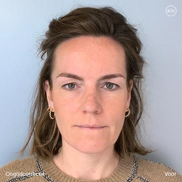 Ooglidcorrectie foto van Easy Cosmetics (voor)