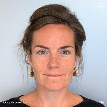 Ooglidcorrectie foto van Easy Cosmetics (na)