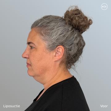 Onderkin verwijderen voor/na van Easy Cosmetics (voor)