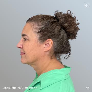 Onderkin verwijderen voor/na van Easy Cosmetics (na)