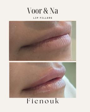 Lipfillers voor/na van Fienouk Aesthetics (voor)