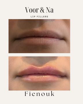 Lipfillers voor/na van Fienouk Aesthetics (na)