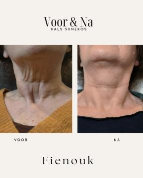 Skinboosters voor/na van Fienouk Aesthetics (voor)