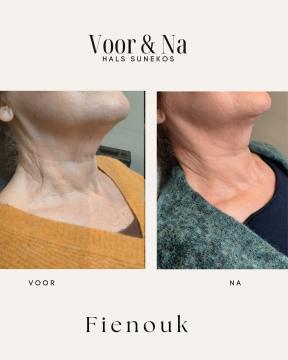 Skinboosters voor/na van Fienouk Aesthetics (na)