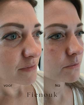 Traangoot filler foto van Fienouk Aesthetics (voor)