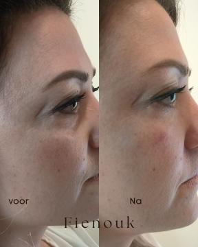 Traangoot filler foto van Fienouk Aesthetics (na)