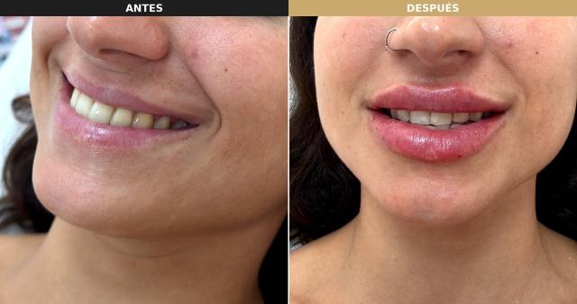 Lippen Opvullen foto van Clínicas Dra. Yasmin Sevilla (na)