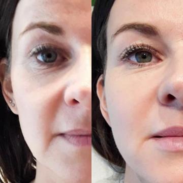 Foto Profhilo de Jenaesthetik – Praxis für ästhetische und ganzheitliche Behandlungen (antes)