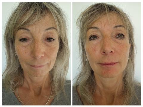 Foto Profhilo de Jenaesthetik – Praxis für ästhetische und ganzheitliche Behandlungen (después)