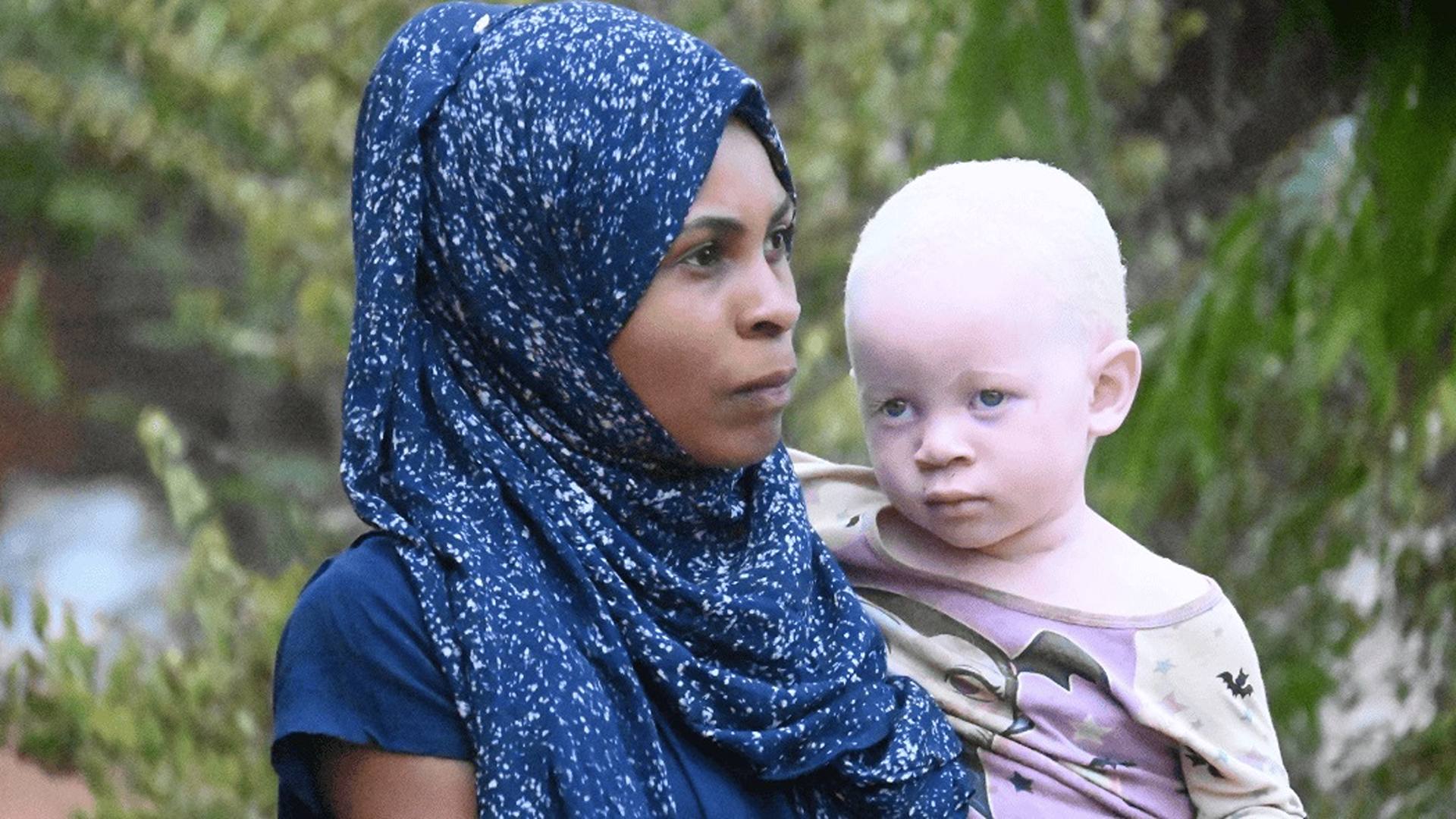 ADRA-Internazionale-Albinismo-Tanzania-1