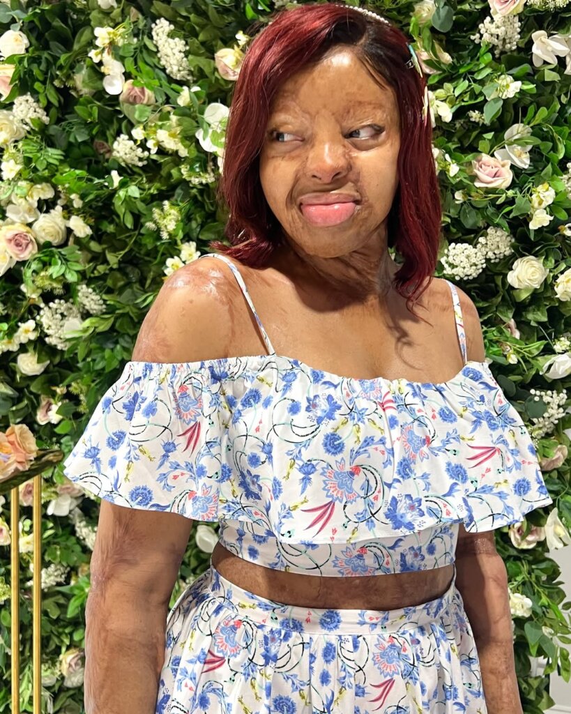 Kechi Okwuchi, a burn survivor, via @kechiofficial on Instagram